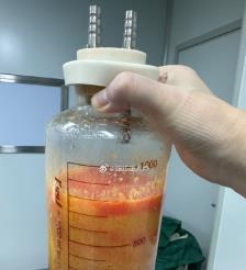 宜都水动力吸脂手术要做多久？